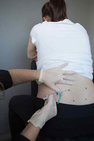 Picture of a person’s lower back marked with four x’s. Another person has their hand on their back with one hand and an injection needle in the other.